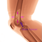 Probiotics applications in bone cancer treatment