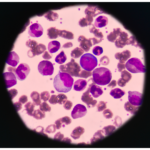 Leukemia treatment using umbilical cord stem cells