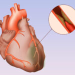 Mesenchymal stem cell in treatment for Ischemic heart disease