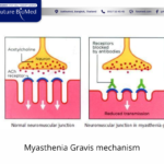 MSC-CM potential for Myasthenia Gravis Treatment