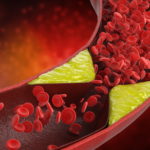 Stroke treatment using umbilical cord stem cells