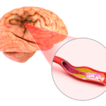 Stem cell therapy in post-stroke treatment and recovery