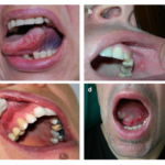 Probiotics Applications in Treating Oral Mucositis