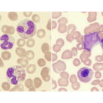 Umbilical Cord Blood in the Treatment of Myelodysplastic Syndrome