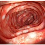 Application of probiotics in the prevention and management of ulcerative colitis
