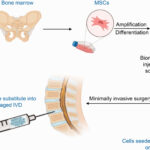 Regenerative Disc Treatment Using Mesenchymal Stem Cells (MSCs): Transforming Spine Health at Future Biomed Bangkok Rejuvenation Center